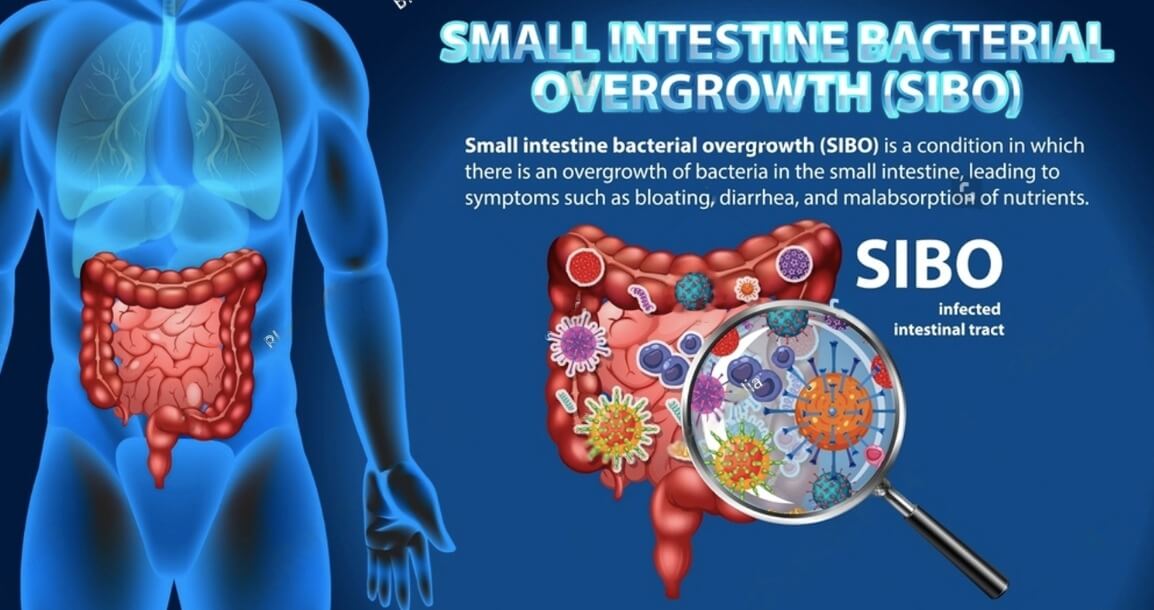 SIBO