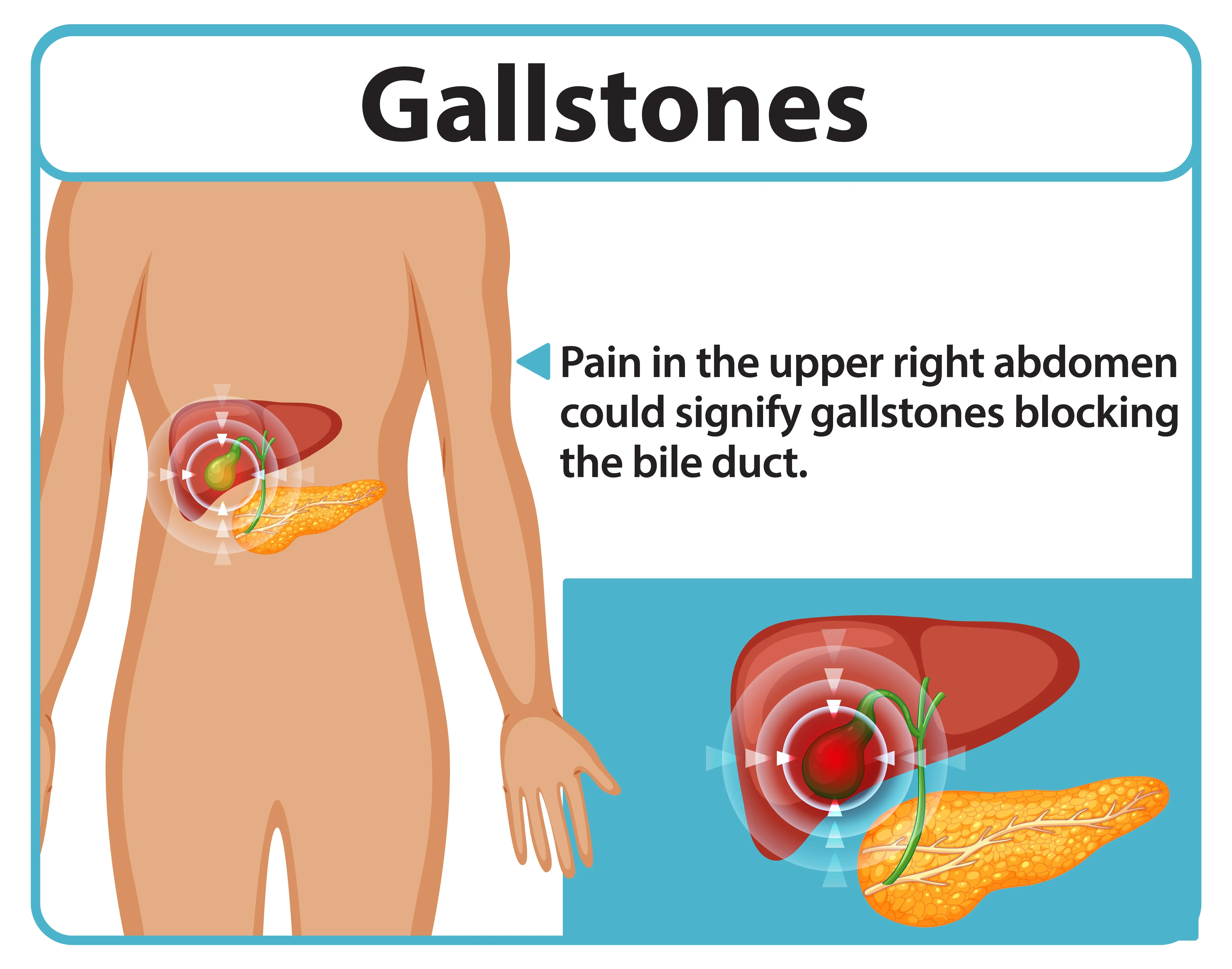 gallstones