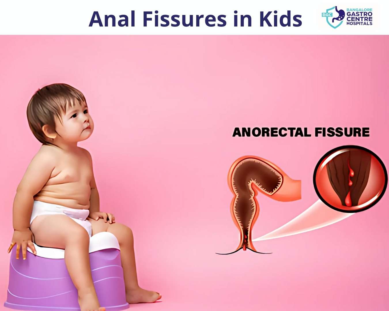 Anal fissures in kids – Baby on a potty with an anatomical diagram showing anorectal fissure, symptoms, causes, and bleeding. Pediatric constipation and digestive health awareness.