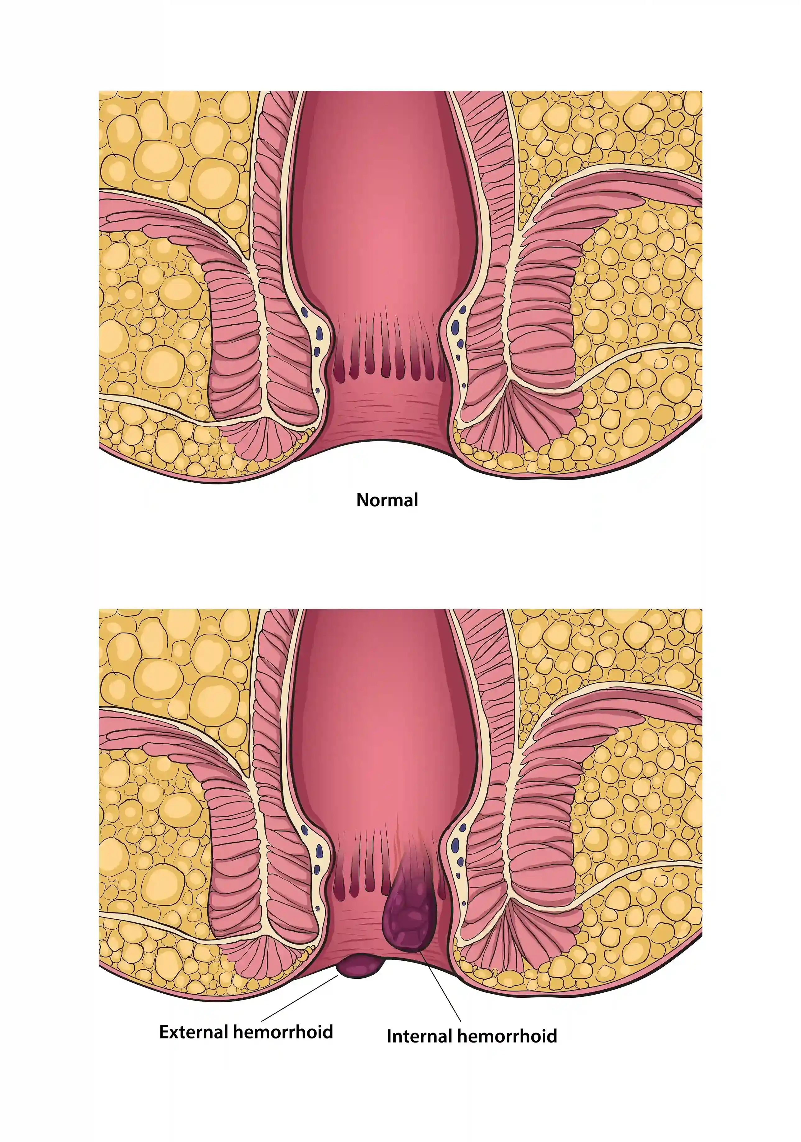 Anal Skin Tags Causes, Safe Removal & Treatment Guide