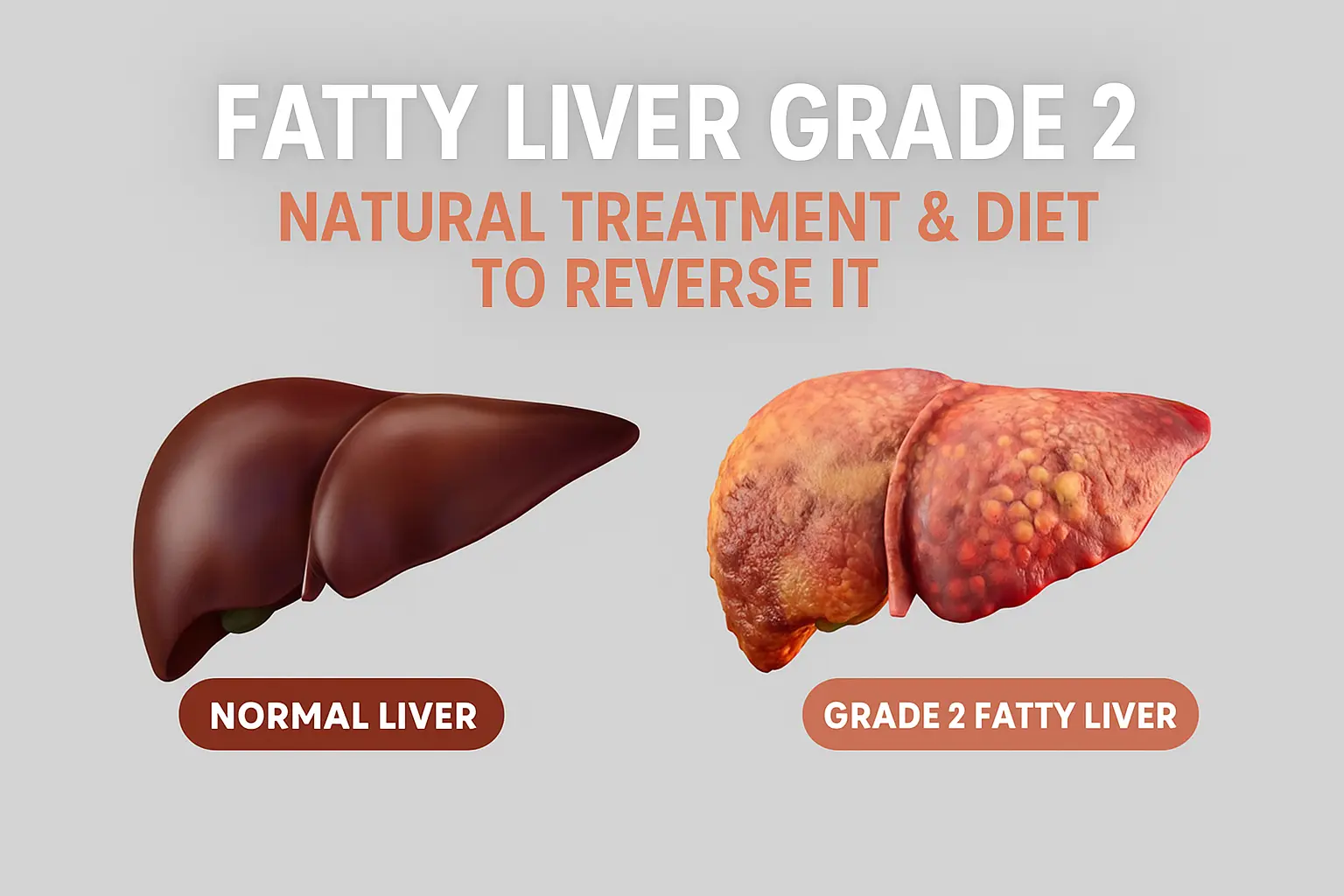 Fatty Liver Grade 2 Natural Treatment & Diet to Reverse It