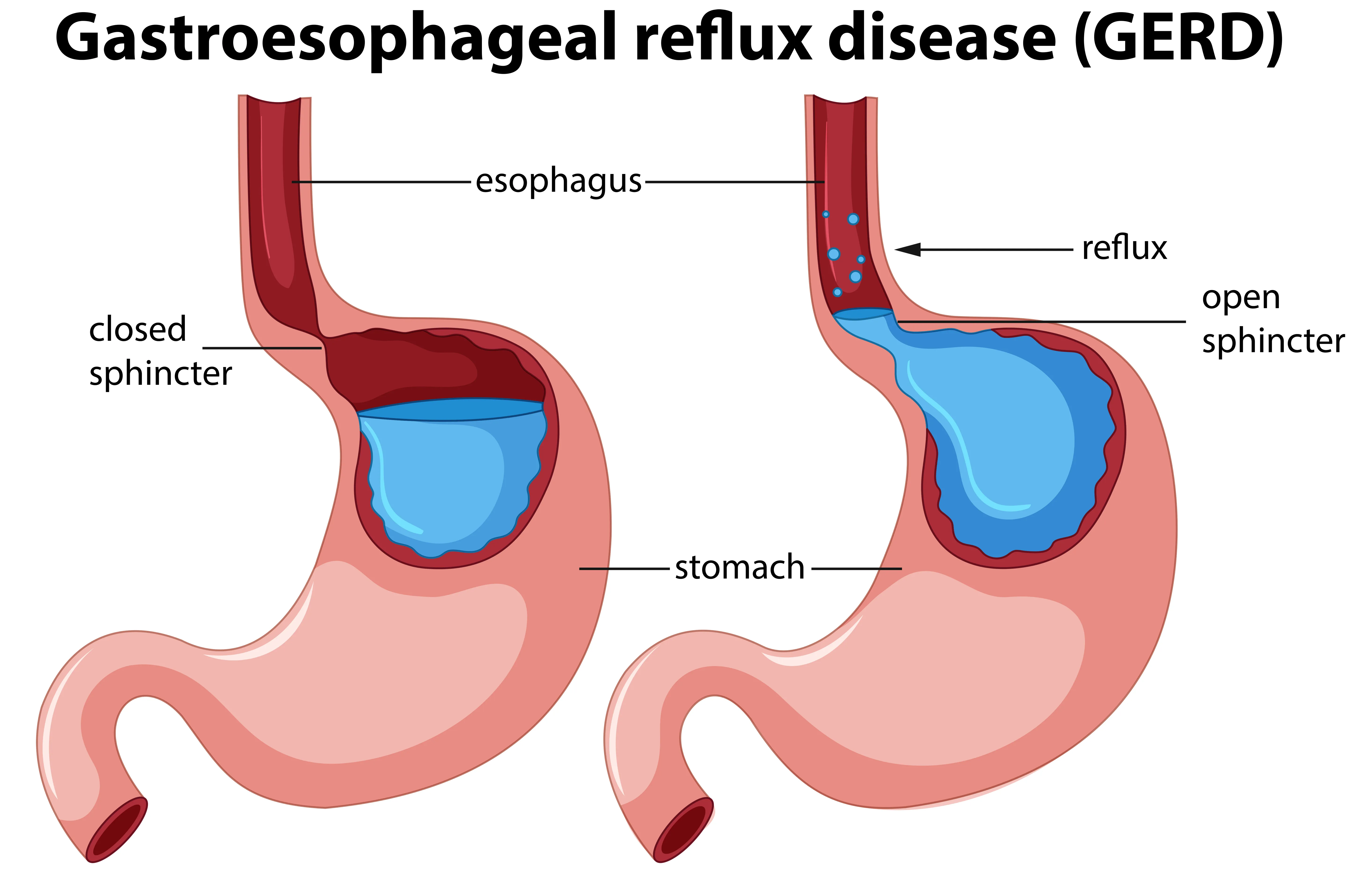 GERD (Acid Reflux): Symptoms, Diagnosis & Treatment Options