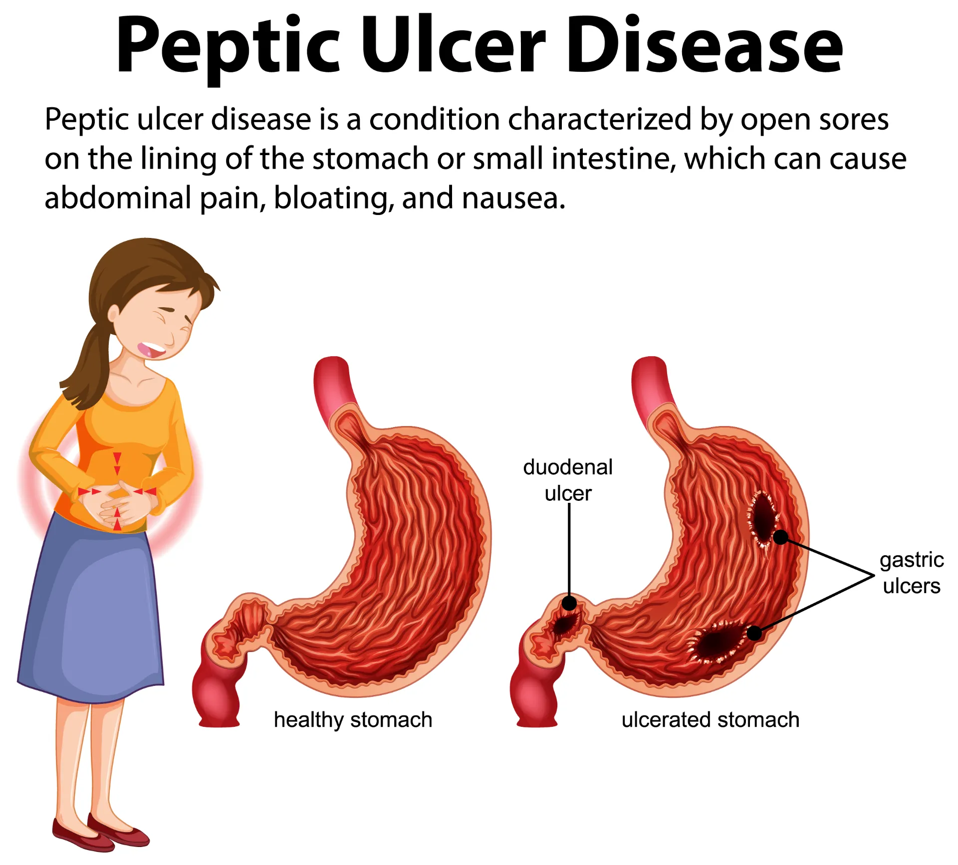 Peptic Ulcer Treatment: A Complete Healing Guide