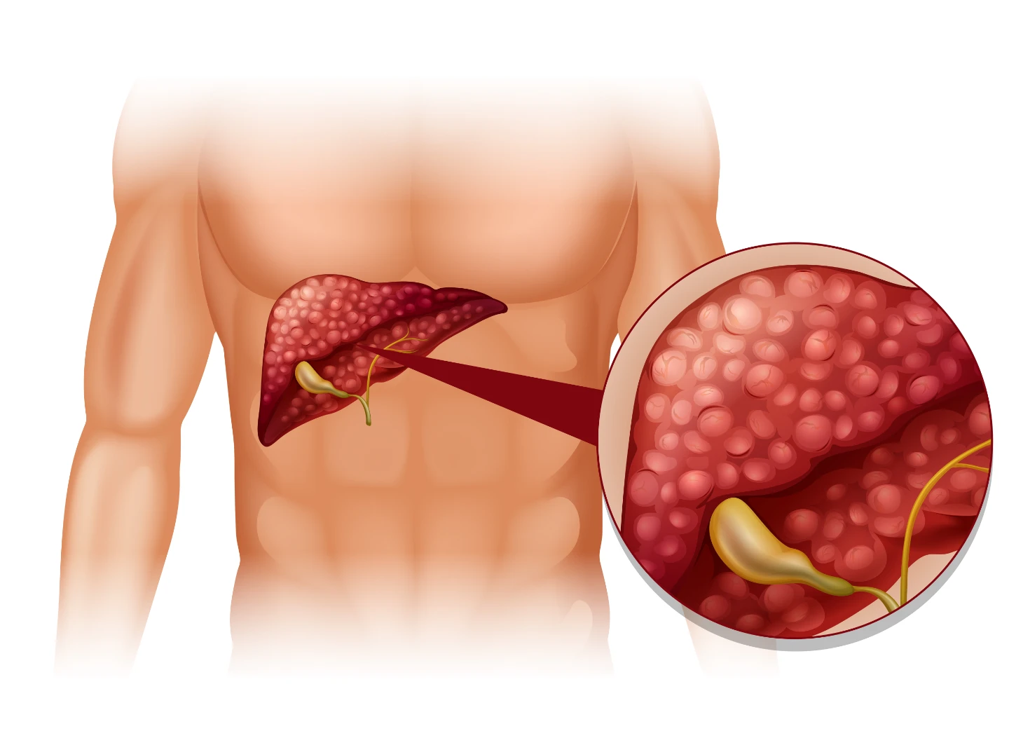 Gallbladder Polyps: Causes, Diet & Surgery Guide